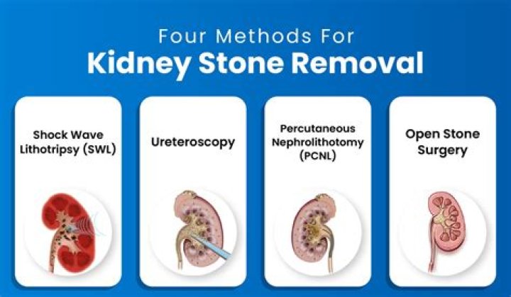 Does soda break kidney stones?
