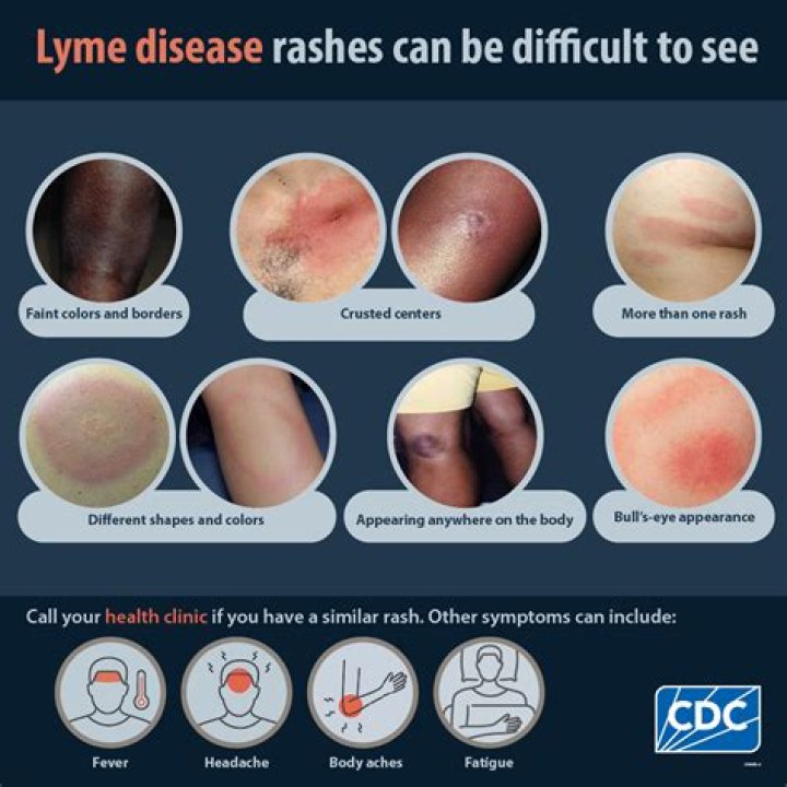 Does Stills disease go away?
