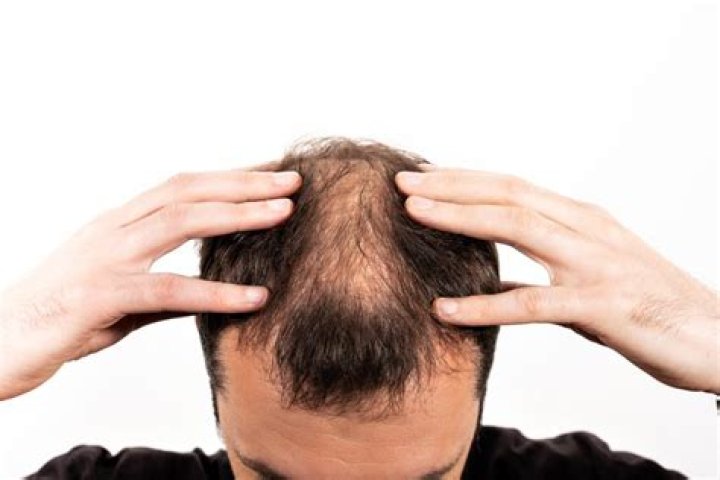 Does testosterone make you bald?