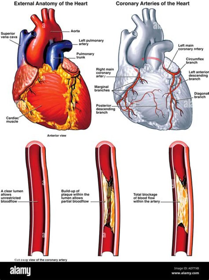 How are blocked heart arteries treated?