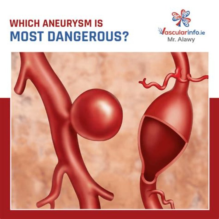 How big is a stomach aneurysm?