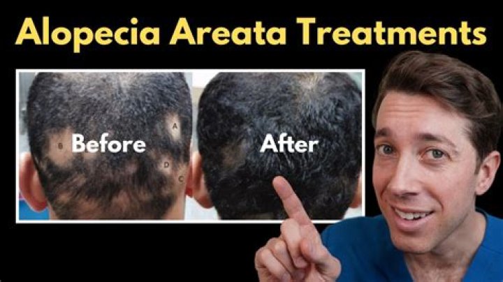 How can I fix my alopecia areata naturally?