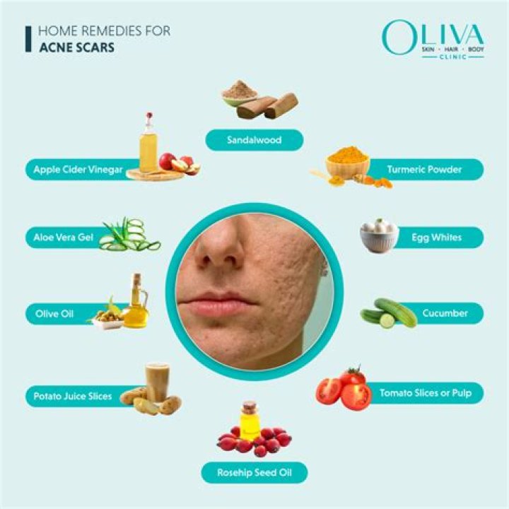 How can I improve my acne naturally?