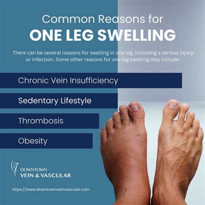 How can I reduce swelling in my legs from arthritis?