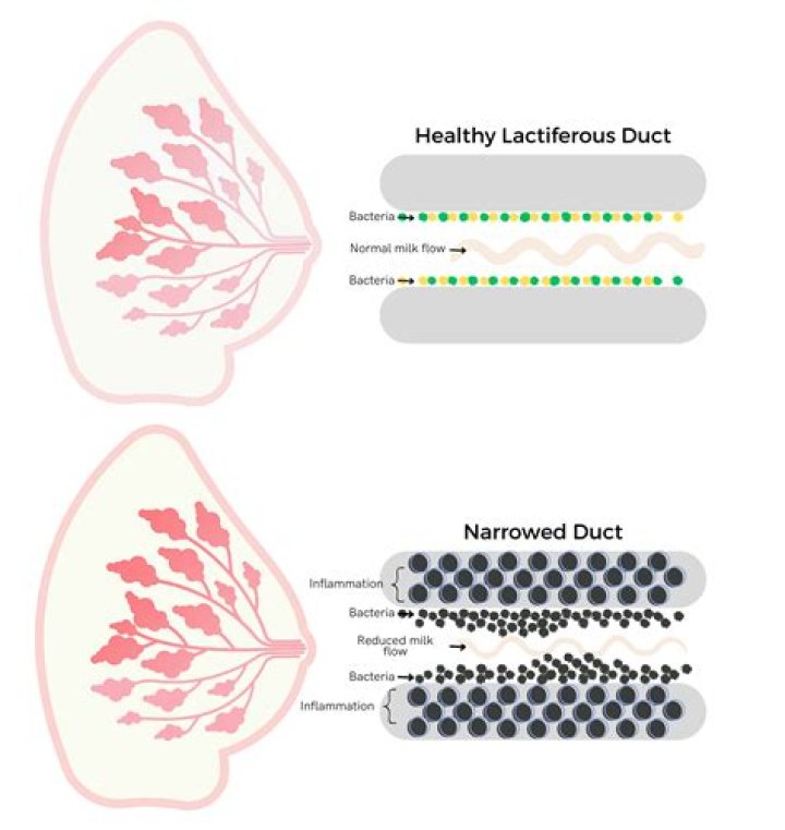 How can you tell the difference between a blocked duct and mastitis?