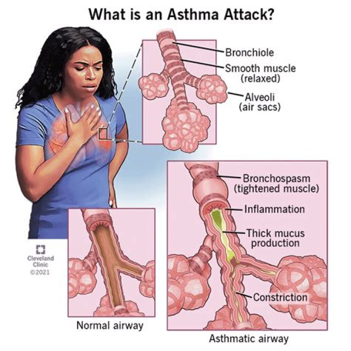 How common is asthma in Europe?