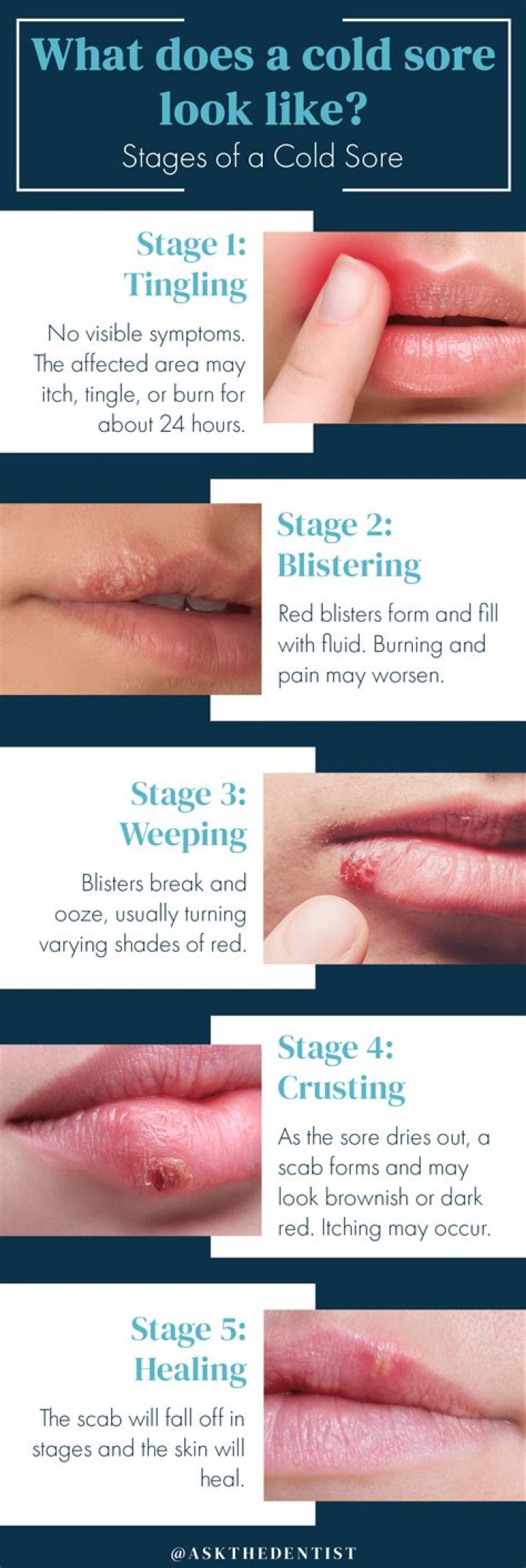 How do I get rid of a cold sore fast UK?