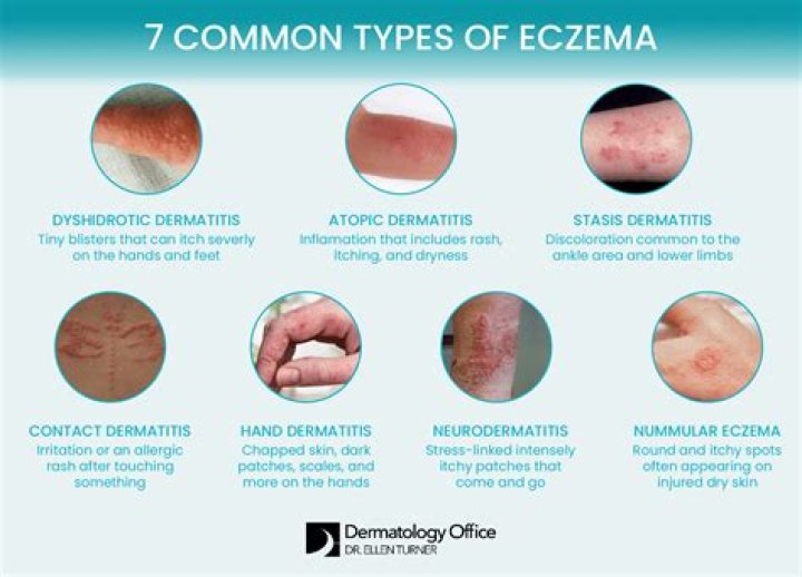How do I get rid of eczema around my nose?