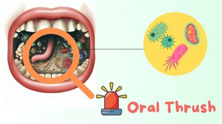 How do I know if my oral thrush is getting worse?