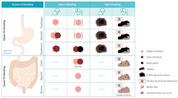 How do I manage LGIB?