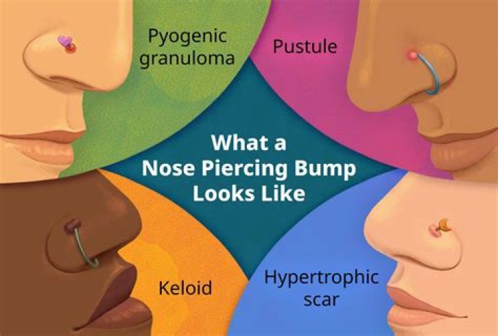 How do I reduce the bump on my nose?