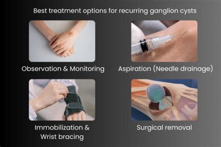 How do they remove a cyst from your chest?