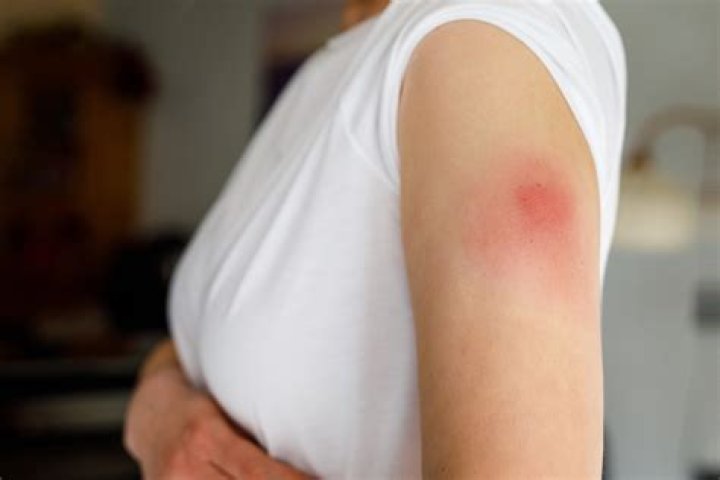 How do u get a staph infection?
