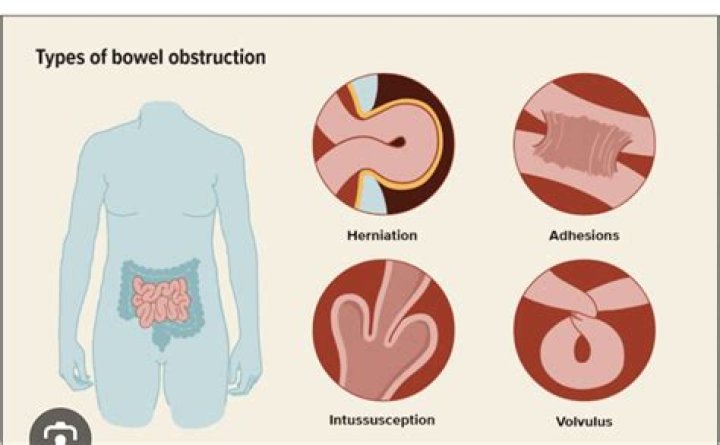 How do you clear your bowels with a prolapse?