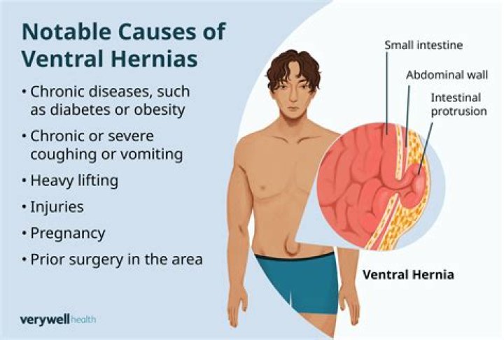How do you confirm a hernia?