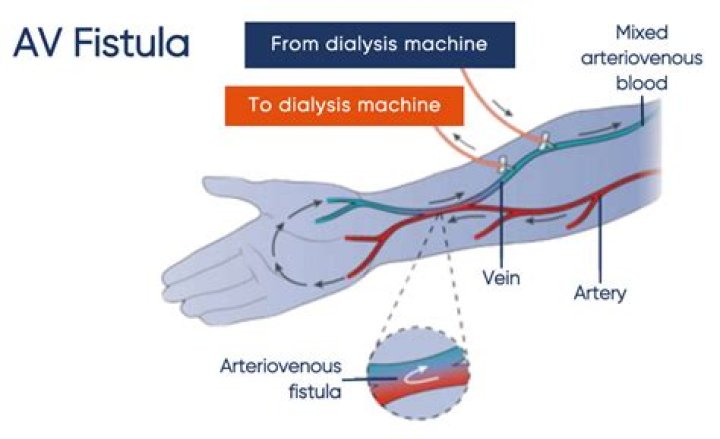 How do you create an arteriovenous fistula?