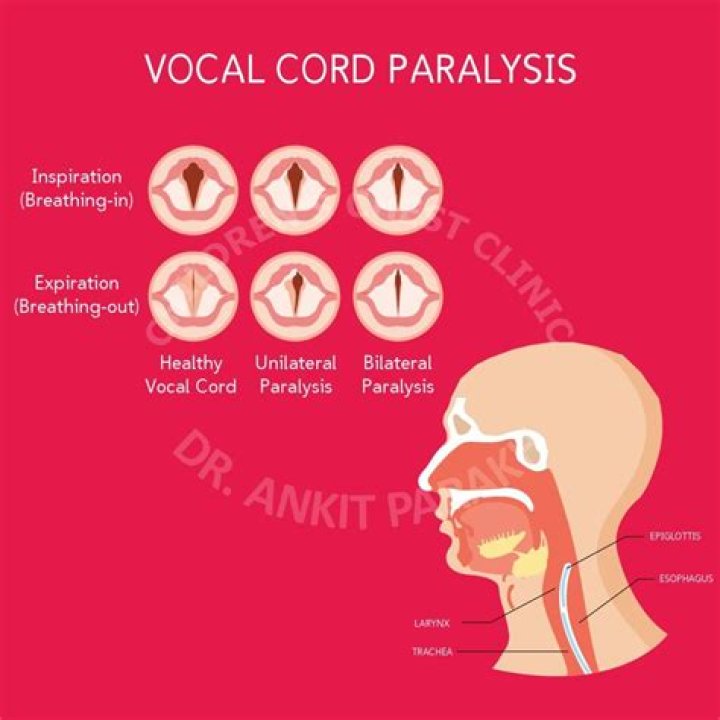 How do you cure paresis vocal cords?