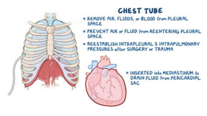 How do you detect hemothorax?