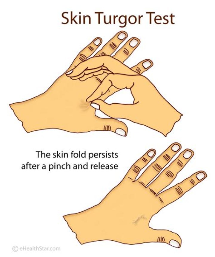 How do you document skin turgor?