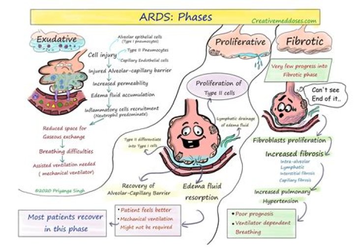 How do you explain ARDS to patients?