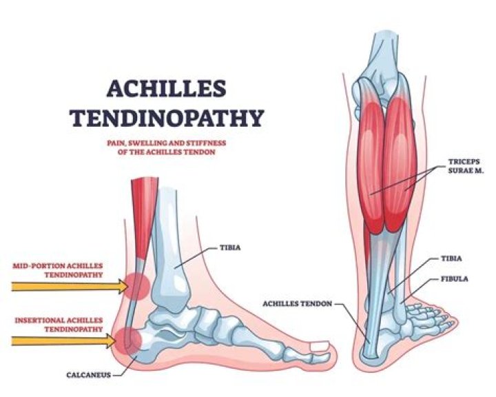 How do you fix Achilles tendonitis?