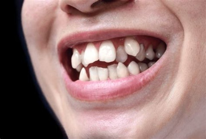 How do you fix overlapping teeth?