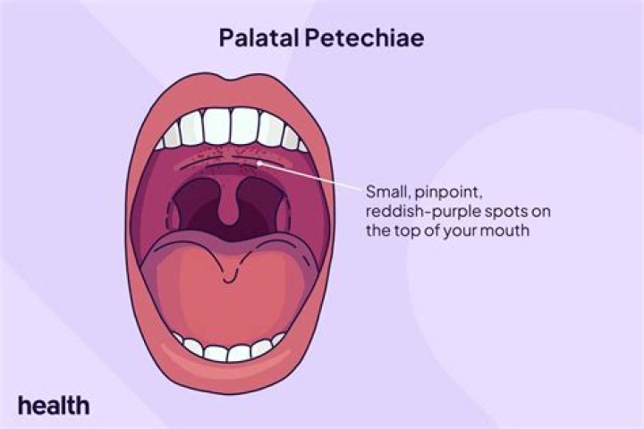 How do you get rid of palatal petechiae?