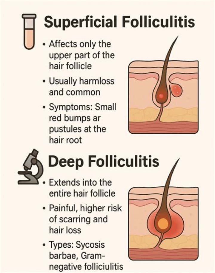 How do you get rid of scalp folliculitis?