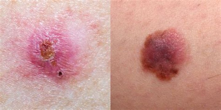 How do you get rid of skin cancer on the back?