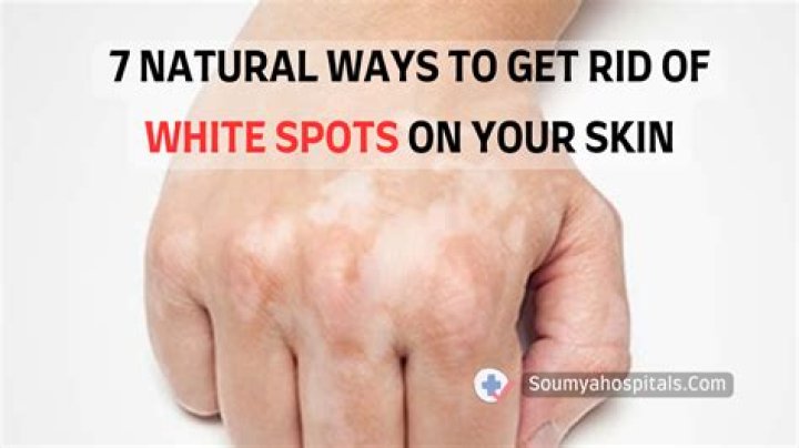 How do you get rid of white spots from sunburn?