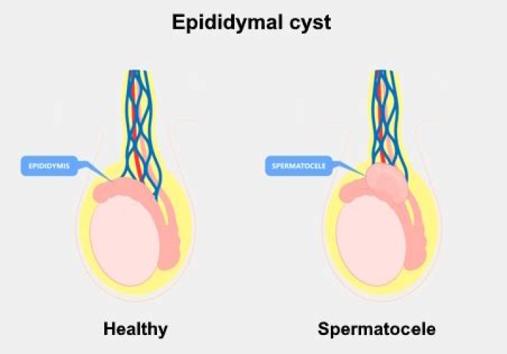 How do you get Spermatocele?