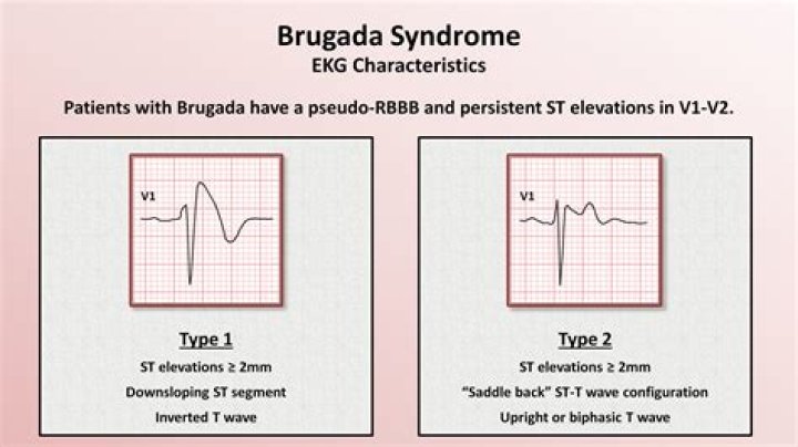 How do you identify an ECG Brugada?