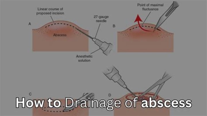 How do you incision and drain an abscess?