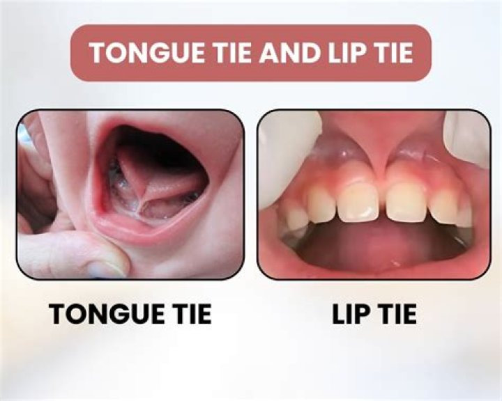 How do you know if you have a tongue and lip tie?