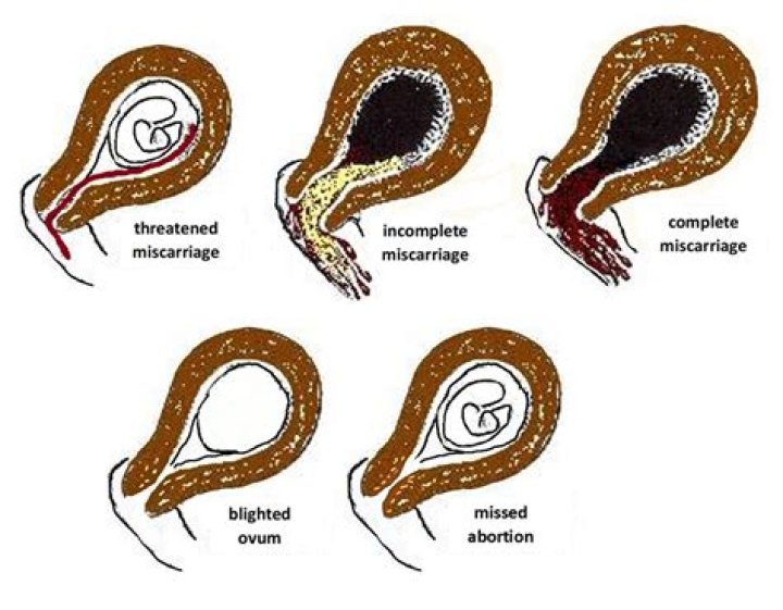 How do you know if you miscarried in the first week?