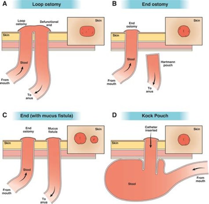 How do you manage high ileostomy output?