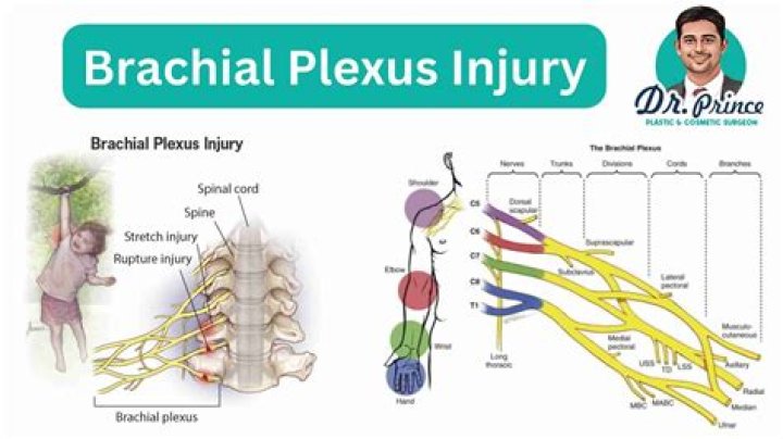 How do you treat a brachial plexus injury?