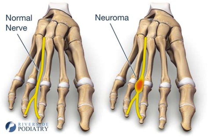 How do you treat a neuroma in the hand?