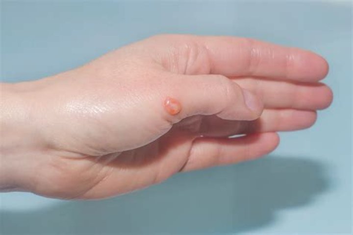 How do you treat a rug burn?