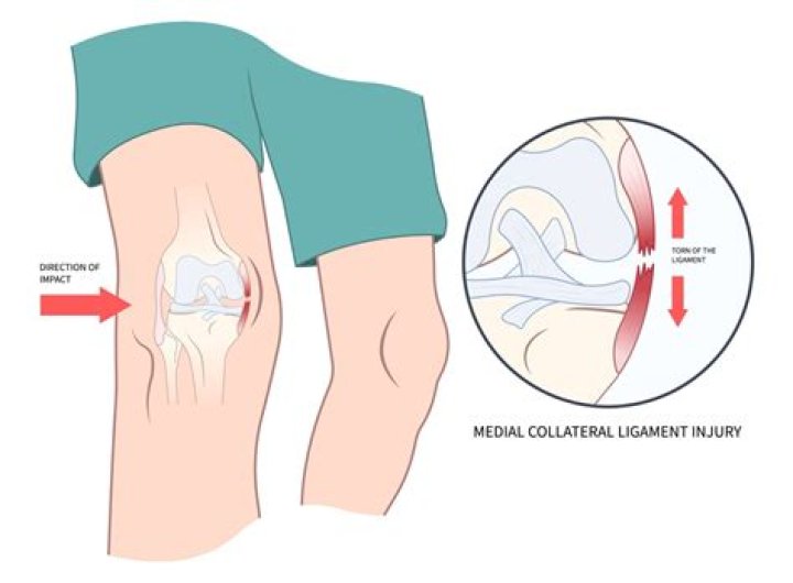 How do you treat a sprained medial collateral ligament?