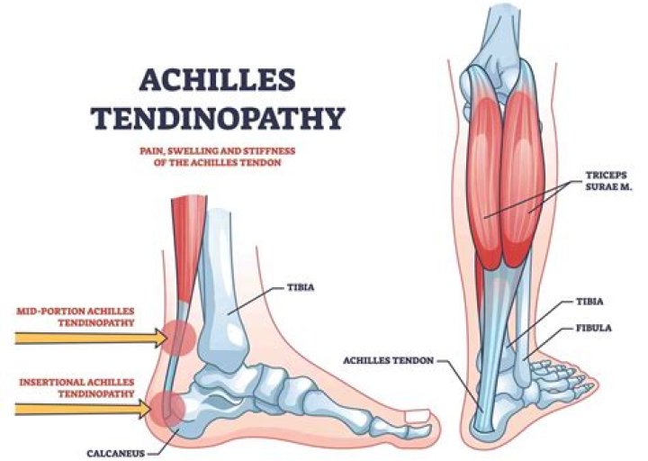How do you treat Achilles Peritendinitis?