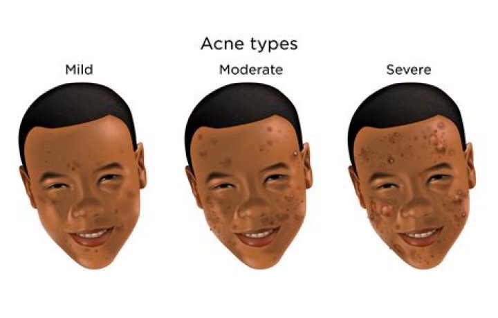 How do you treat acne during steroid cycle?