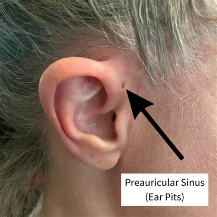 How do you treat an infected preauricular sinus?