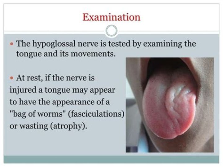 How do you treat hypoglossal nerve damage?
