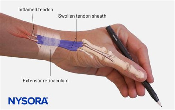 How do you treat inflammation of the tendon sheath?