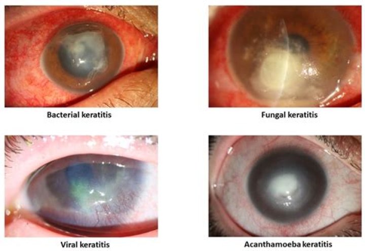 How do you treat interstitial keratitis?