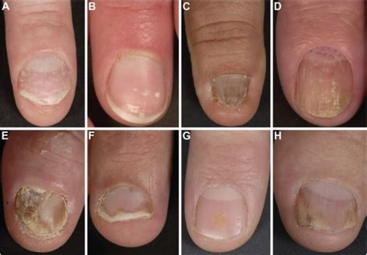 How do you treat nail deformities?
