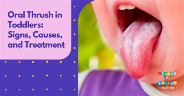 How do you treat oral thrush in a 2 year old?