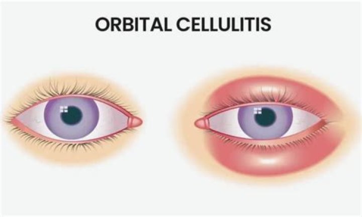 How do you treat orbital cellulitis?