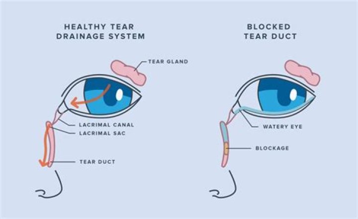 How do you unclog a duct after weaning?